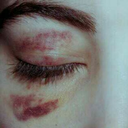 contusions-pain-cuts-blood avatar