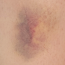 mysterylegbruise avatar